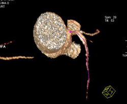 Diseased LAD - CTisus CT Scan