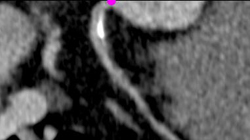 Diseased LAD - CTisus CT Scan