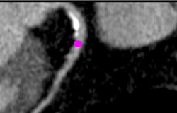 Diseased LAD - CTisus CT Scan