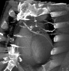 Bypass Grafts - CTisus CT Scan