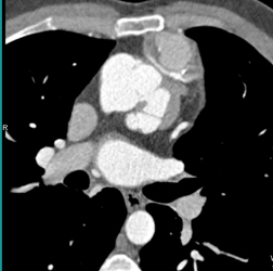 Coronary Artery Aneurysms of Bypass Grafts - CTisus CT Scan