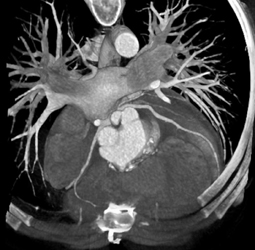 Left Coronary Artery and RCA Arise From A Common Trunk - CTisus CT Scan