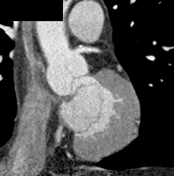 Diseased LAD - CTisus CT Scan