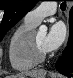 Normal RCA - CTisus CT Scan