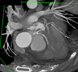 Plaque in LAD - CTisus CT Scan