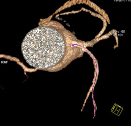 Plaque in LAD - CTisus CT Scan