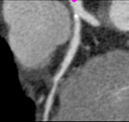 Plaque in LAD - CTisus CT Scan