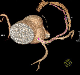 Diseased Circumflex Artery (CX) Coronary Artery - CTisus CT Scan