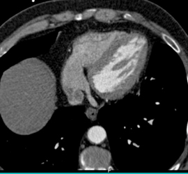 Thinning of Apex of Left Ventricle - CTisus CT Scan