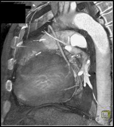 Bypass Grafts - CTisus CT Scan