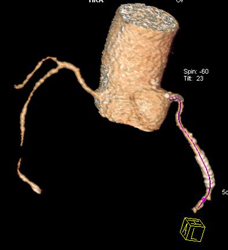 Patent LAD Stent - CTisus CT Scan