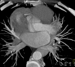 Normal Left Atrium - CTisus CT Scan