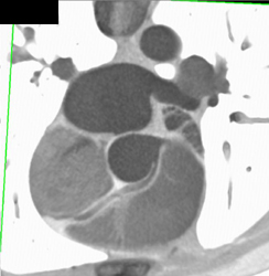 Right Coronary Artery Arises Off of the Left Cusp - CTisus CT Scan