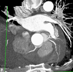 Ramus Intermedius Nicely Shown - CTisus CT Scan