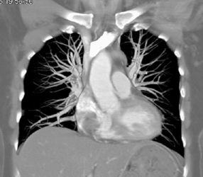 Clot in Right Atrium - CTisus CT Scan