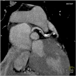 Calcified LAD Plaque - CTisus CT Scan