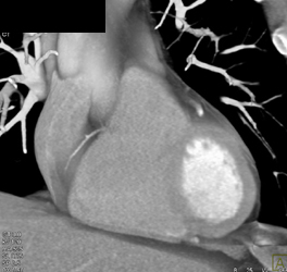 Small RCA in Left Dominant Circulation With Prominent Left Circumflex Artery (CX) - CTisus CT Scan