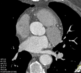 Multivessel Disease With Soft and Calcified Plaque - CTisus CT Scan