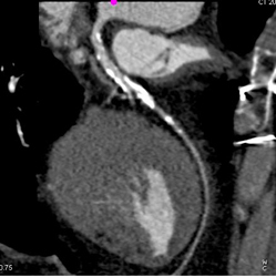 LAD Stenosis Greater Than 50% - CTisus CT Scan