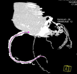 Plaque in But Patent RCA - CTisus CT Scan