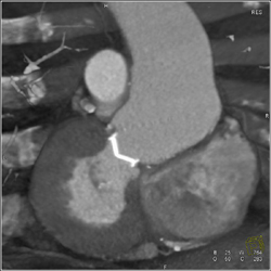 Normal Aortic Valve Replacement (AVR) - CTisus CT Scan