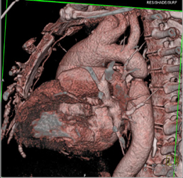 Coarctation of the Aorta With Dilated Ascending Aorta and Bicuspid Valve - CTisus CT Scan