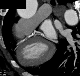 Extensive Disease in LAD and Circumflex - CTisus CT Scan