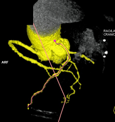 Greater Than 50% Stenosis in LAD - CTisus CT Scan