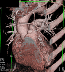 Patent Venous Grafts - CTisus CT Scan