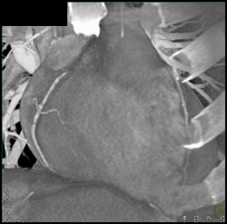 Normal RCA - CTisus CT Scan