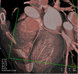 Normal LAD - CTisus CT Scan