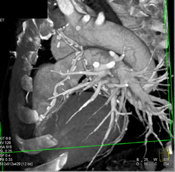 Patent Bypass Grafts - CTisus CT Scan