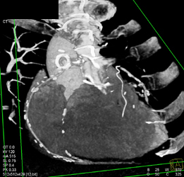 Patent Graft to Right Coronary Artery Circulation - CTisus CT Scan