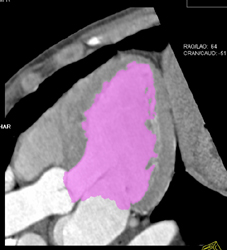 Diastole Vs Systole - CTisus CT Scan