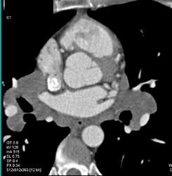 Incidental Detection of Sarcoidosis - CTisus CT Scan