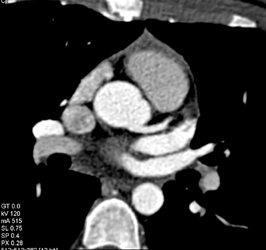 Normal Coronary Artery - CTisus CT Scan