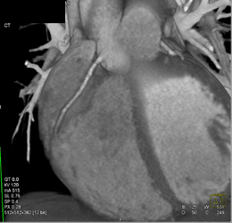 Normal Coronary Artery - CTisus CT Scan