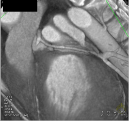 Normal Coronary Artery - CTisus CT Scan