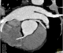 Normal Coronary Artery - CTisus CT Scan