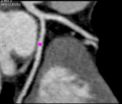 Normal Coronary Artery - CTisus CT Scan