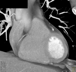 Normal Coronary Artery - CTisus CT Scan