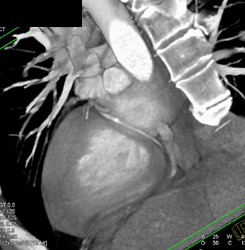 LAD Plaque - CTisus CT Scan