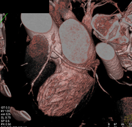 LAD Plaque - CTisus CT Scan