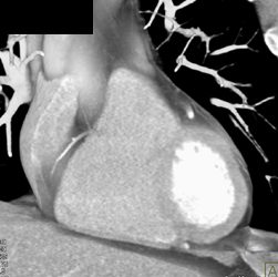 LAD Plaque - CTisus CT Scan