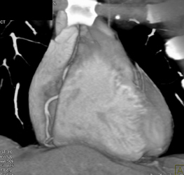 Normal RCA - CTisus CT Scan