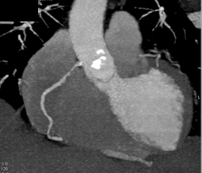 Diseased Proximal RCA - CTisus CT Scan