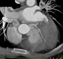 Diseased LAD - CTisus CT Scan