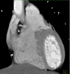 Normal RCA - CTisus CT Scan