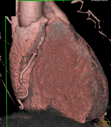 Normal RCA - CTisus CT Scan