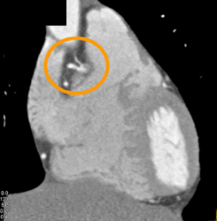 Normal RCA - CTisus CT Scan